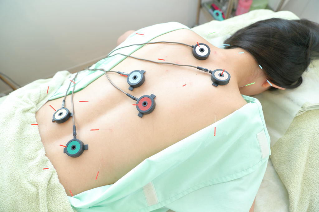 治療台の上で首・肩から背中まで鍼をうち、さらに電気治療をしている写真